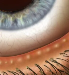 Meibomian Gland Dysfunction