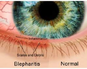 Blepharitis